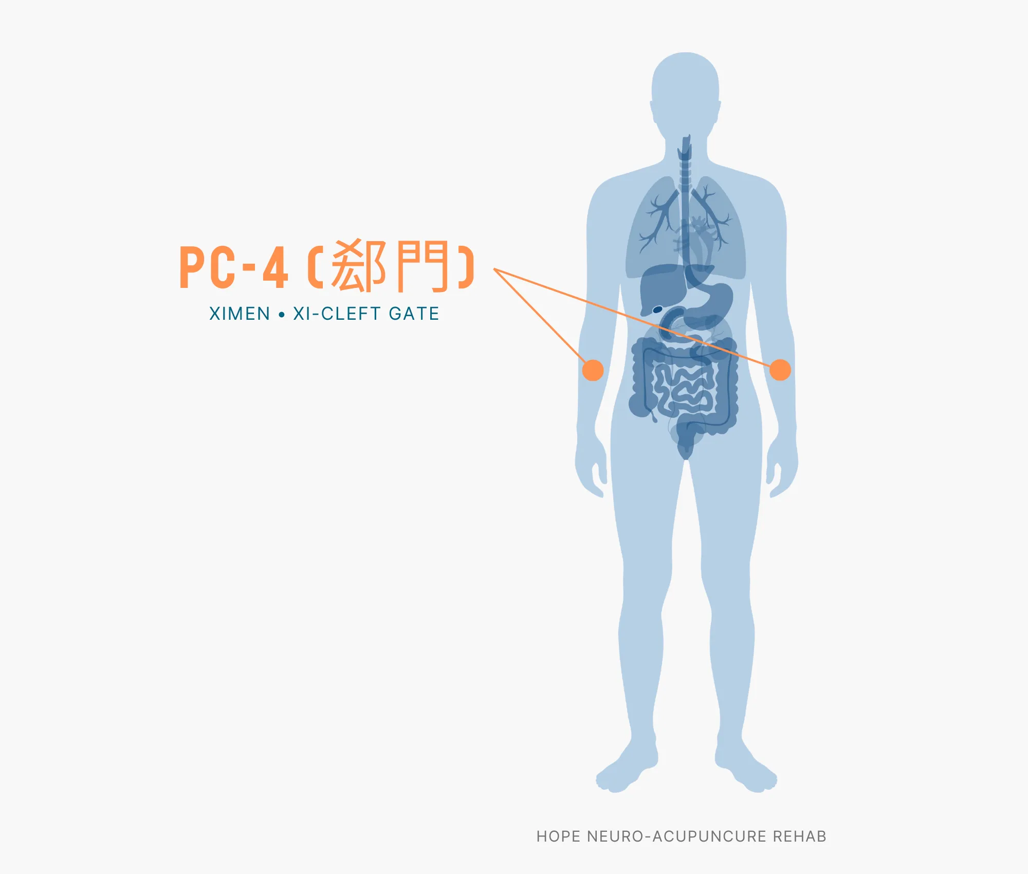 Diagram Showing Where the PC-4 Acupuncture Point (also known as Ximen or Xi-Cleft Gate) is within the Pericardium Meridian