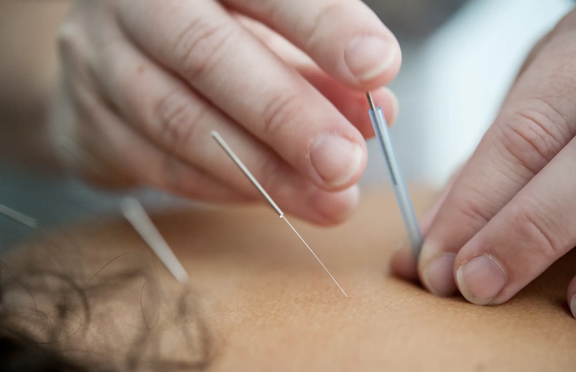acupuncturist taps a needle into patient's forehead.