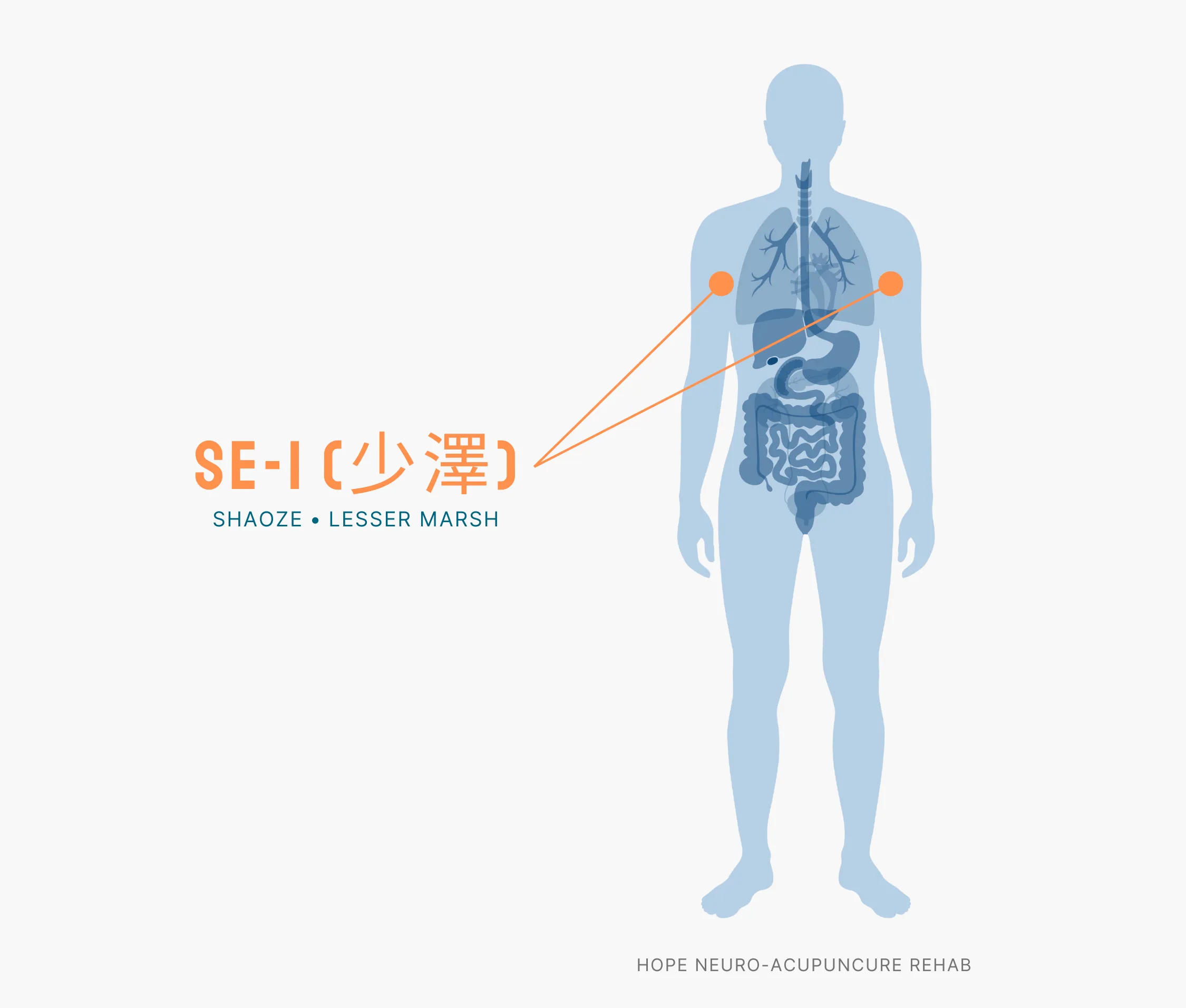 Diagram Showing Where the SI-1 Acupuncture Point (also known as Shaoze or Lesser Marsh) is within the Small Intestine Meridians