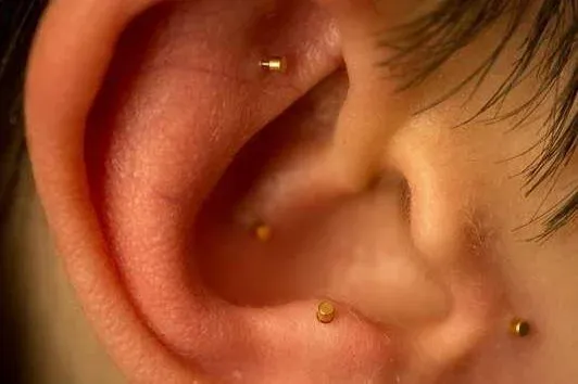 example of the five sites on the ear for battlefield acupuncture