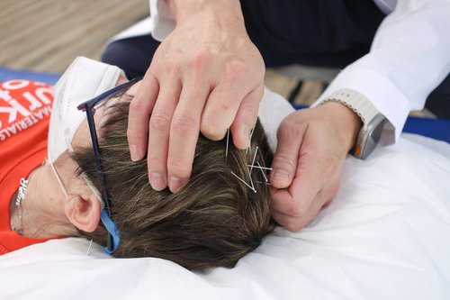 Close-up of scalp acupuncture needle placement on patient during treatment